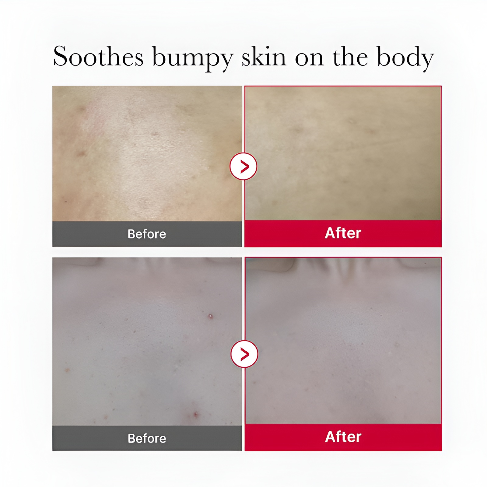 Medicube Red Acne Body Peeling Shot 110g