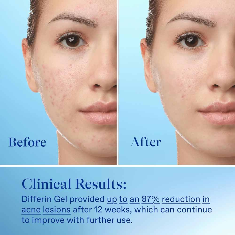 Differin Gel Adapalene 0.1% Acne Treatment (15 g)